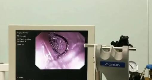 钓鱼钓到宠物狗,医生用内窥镜取出两枚鱼钩 钓鱼钓到宠物狗,医生用内窥镜取出两枚鱼钩