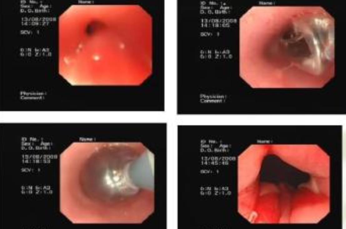内窥镜日常排危解难的使用案例 内窥镜日常排危解难的使用案例